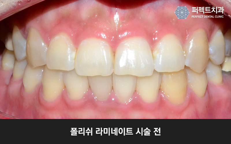 앞니 라미네이트 치아삭제량 확인해보세요! 관련 이미지 4