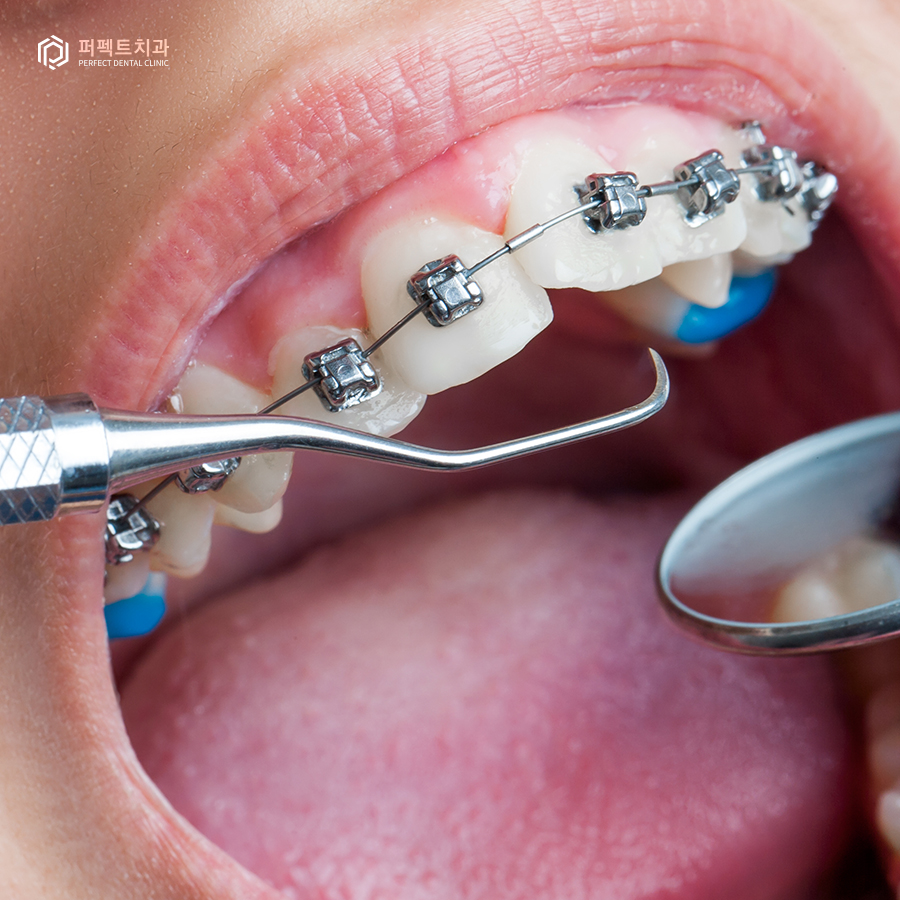 치아교정을 빨리 끝내는 방법이 있다고?! 관련 이미지 2