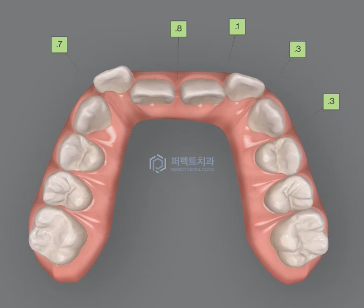 인비절라인 효과 알아보기 (+인비절라인라이트) 관련 이미지 8