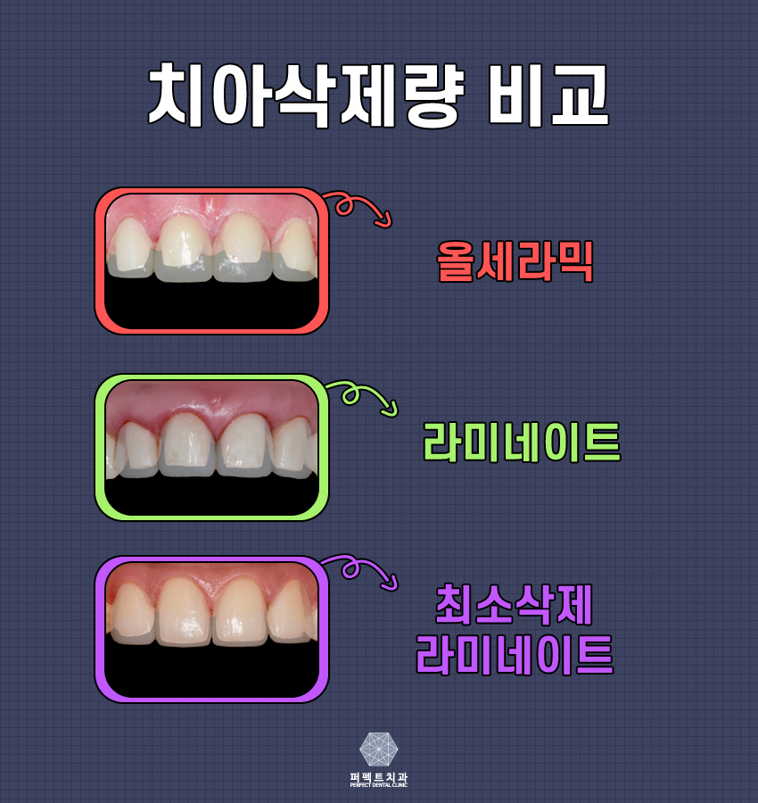 연예인 라미네이트 나도 할래!! 관련 이미지 2