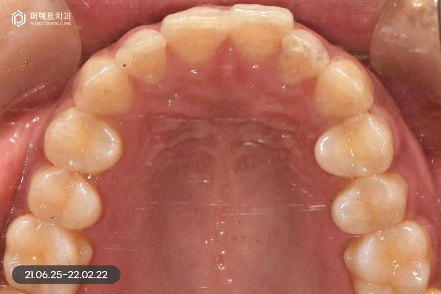 삐뚠 치아도 최소삭제가 가능하게👌🏻 교정 후 폴리네이트 관련 이미지 3