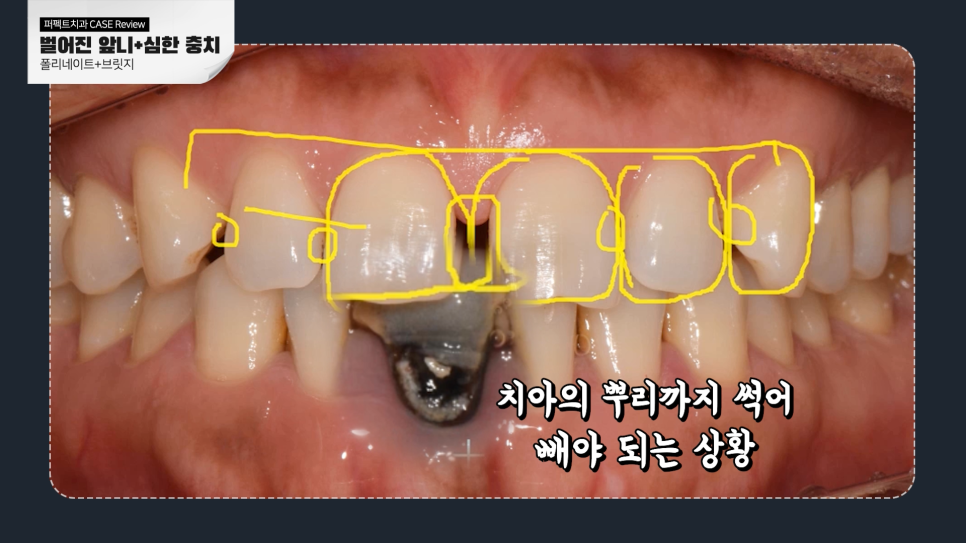 앞니충치, 벌어짐 동시에 치료하는 방법 관련 이미지 4