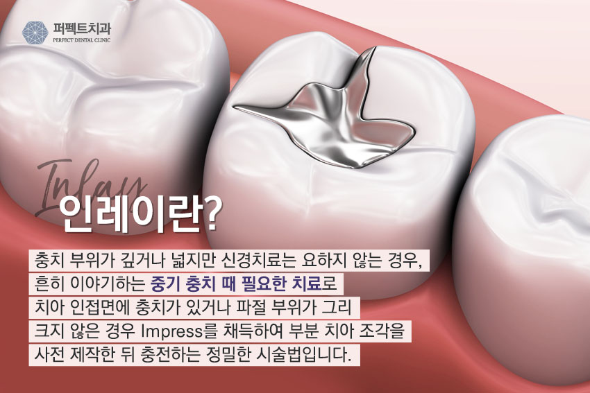 세라믹인레이 충치치료 비용 관련 이미지 1