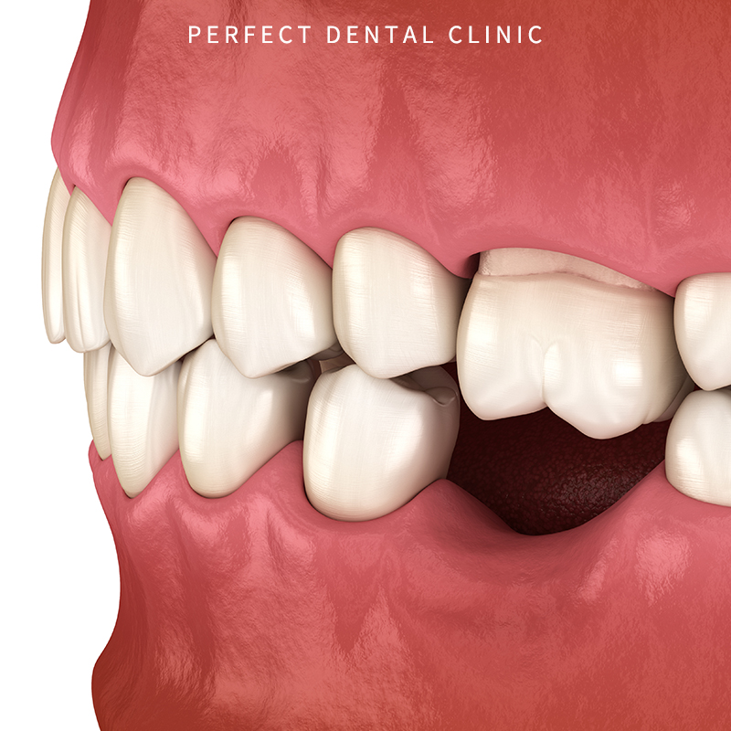 20대 발치 사랑니&임플란트 관련 이미지 1