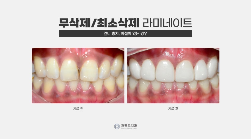 무삭제 라미네이트 추천 및 가능한 케이스 확인하기 관련 이미지 7