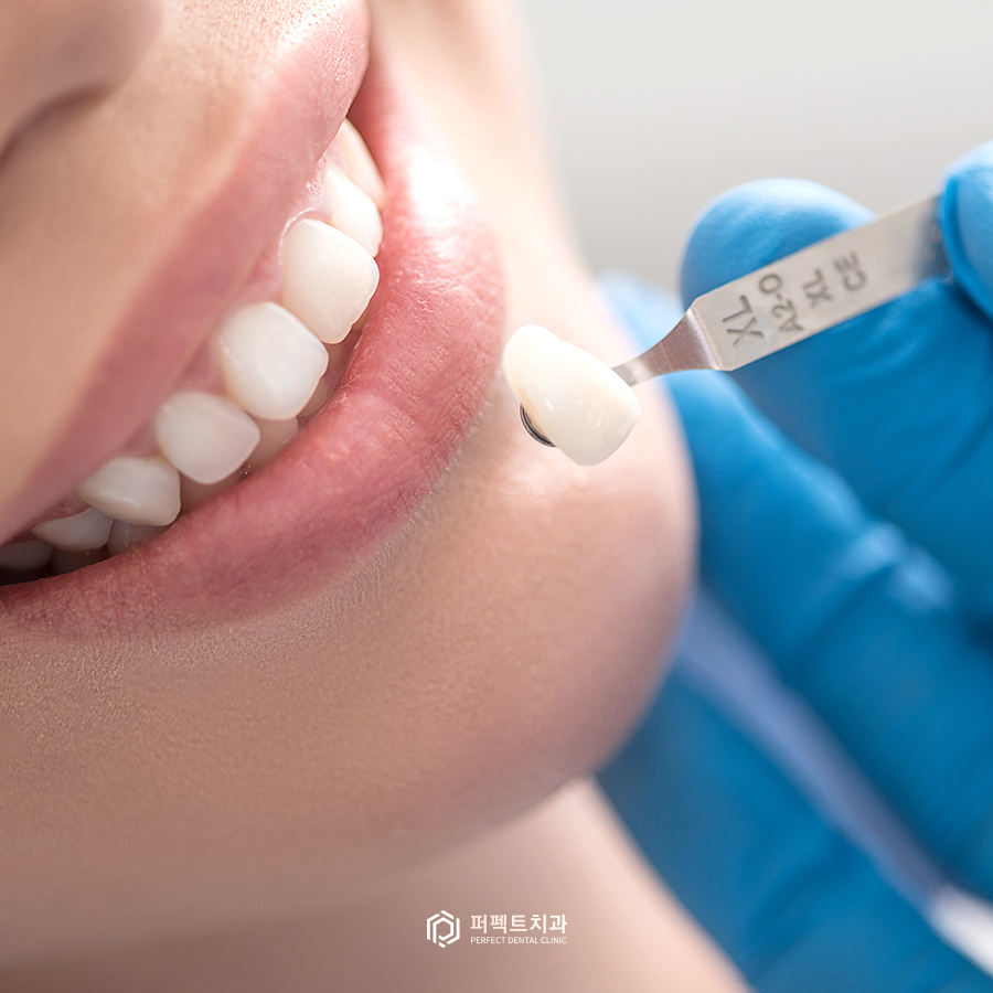 예쁜 라미네이트의 기준이 있나요? 관련 이미지 5