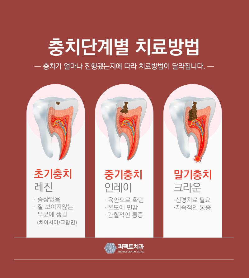 세라믹인레이 충치치료 비용 관련 이미지 4