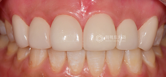 앞니 돌출,벌어짐,변색.. 교정이 싫다면 이 방법으로!? 관련 이미지 8