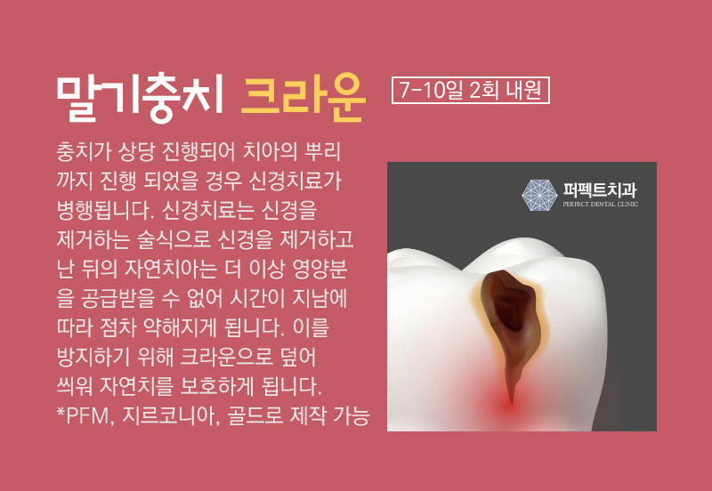 선릉 충치치료 인레이 알아보기! 관련 이미지 8