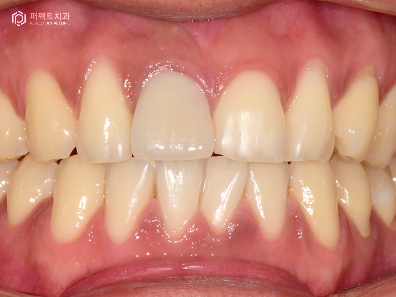 남자라미네이트, 폴리네이트 두가지 케이스 관련 이미지 8