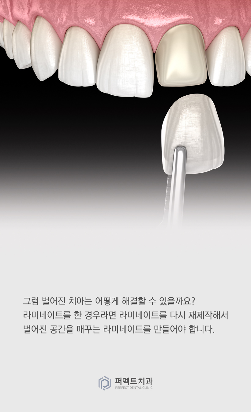 라미네이트를 했는데 앞니가 벌어졌어요! 관련 이미지 4