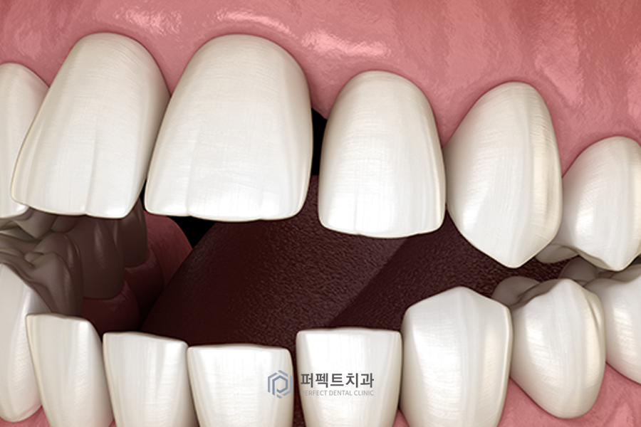 내가 끼고 싶을 때만 끼는 거 아니였어? - 인비절라인에 대한 오해 BEST3 관련 이미지 3