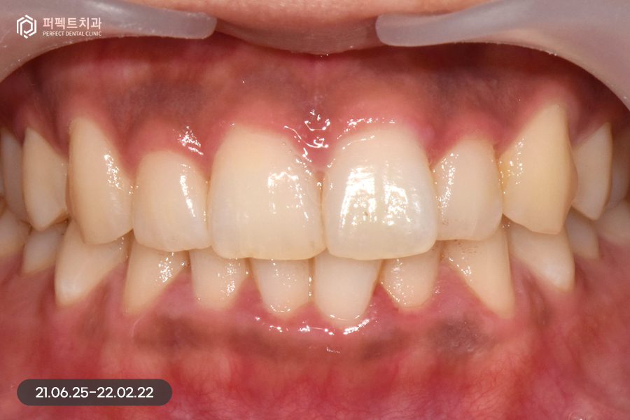 삐뚠 치아도 최소삭제가 가능하게👌🏻 교정 후 폴리네이트 관련 이미지 2
