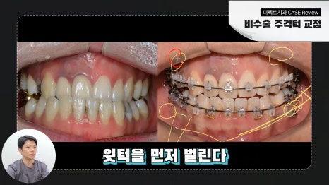 개방교합 주걱턱 교정 후기 관련 이미지 2