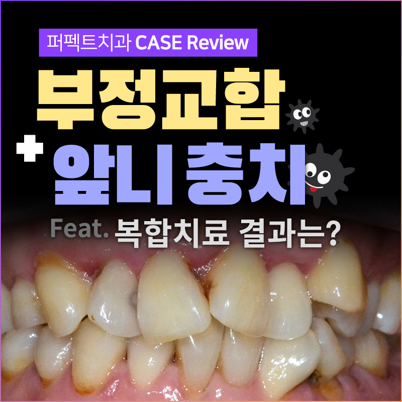 부정교합 치아교정 어떻게? 관련 이미지 1