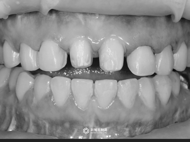 오래된 보철물 교체 및 폴리네이트까지! 관련 이미지 4