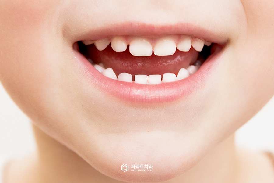 치아에 줄이 있다? 테트라사이클린이란? 관련 이미지 3