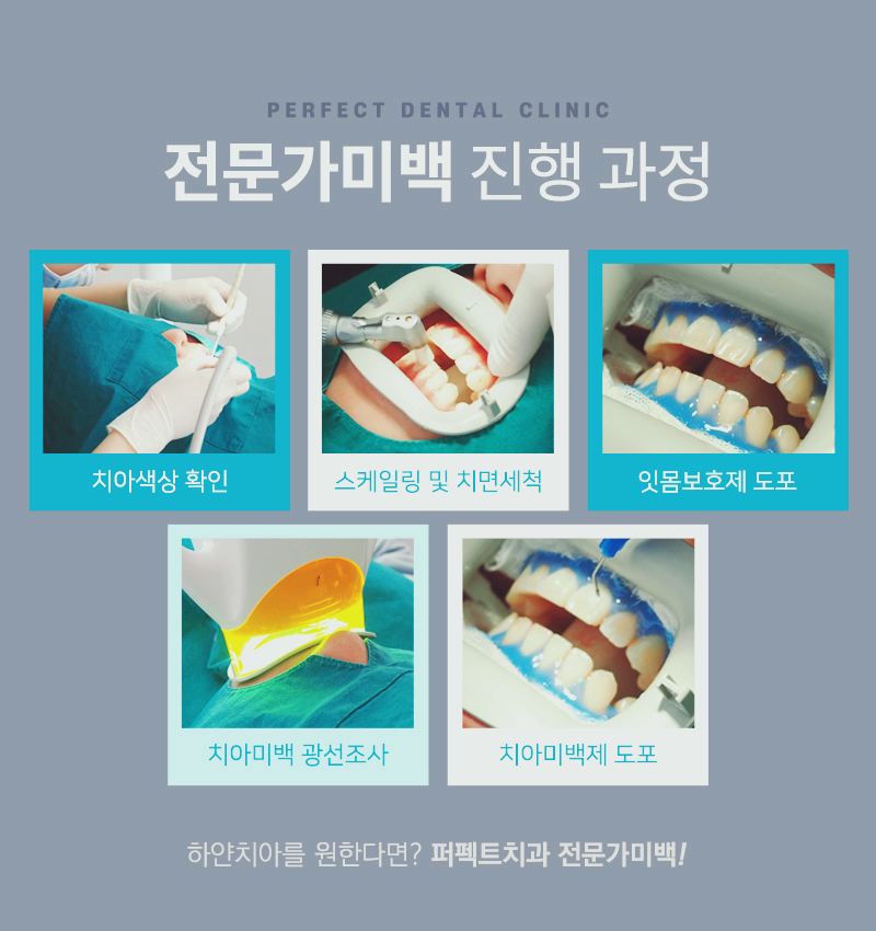 치아미백과정과 치아미백가격 알아보기 관련 이미지 1