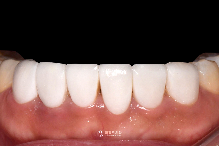 라미네이트 디자인👄｜치과의사가 고른 것vs환자가 고른 것, 어떤 걸로? 관련 이미지 8