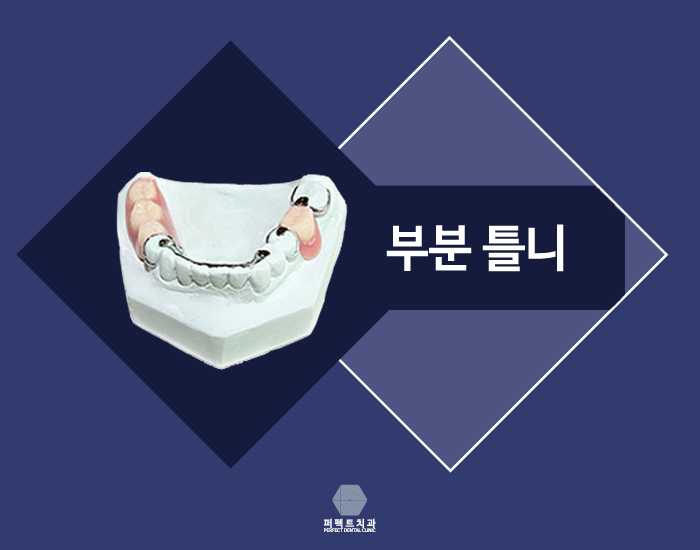 상실한 치아 찾고 싶은데 보철치료 종류에는? 관련 이미지 5