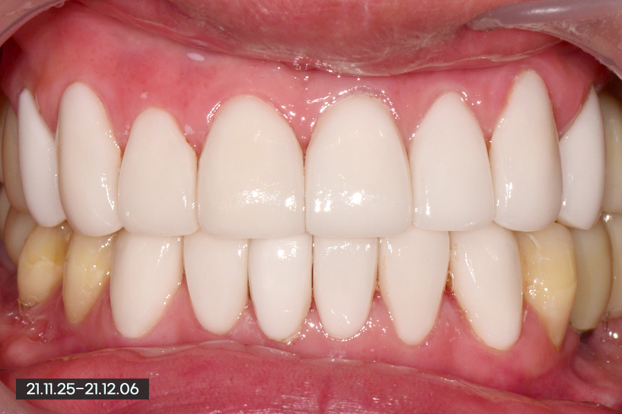 남자 라미네이트, 얼마나 밝게 가능할까? 관련 이미지 5
