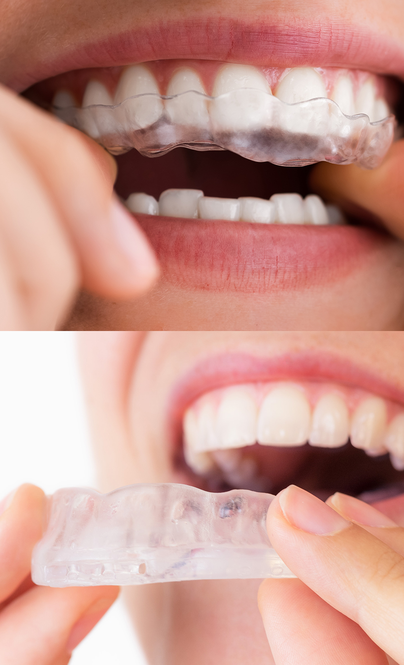 이갈이 하는데 라미네이트 가능한가요? 관련 이미지 4