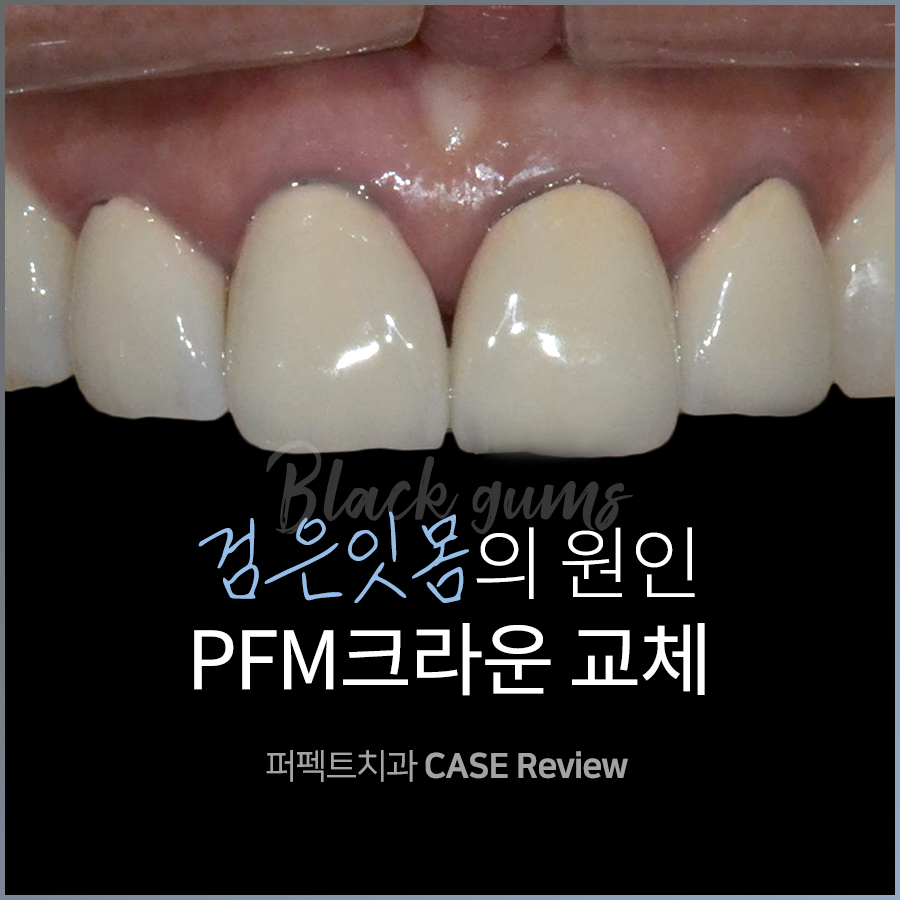 검은 잇몸의 원인, PFM크라운 교체 관련 이미지 1
