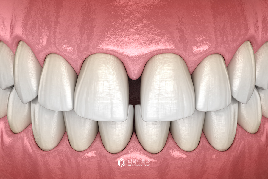 보철치료 후 치아가 벌어지는 이유는? 관련 이미지 1
