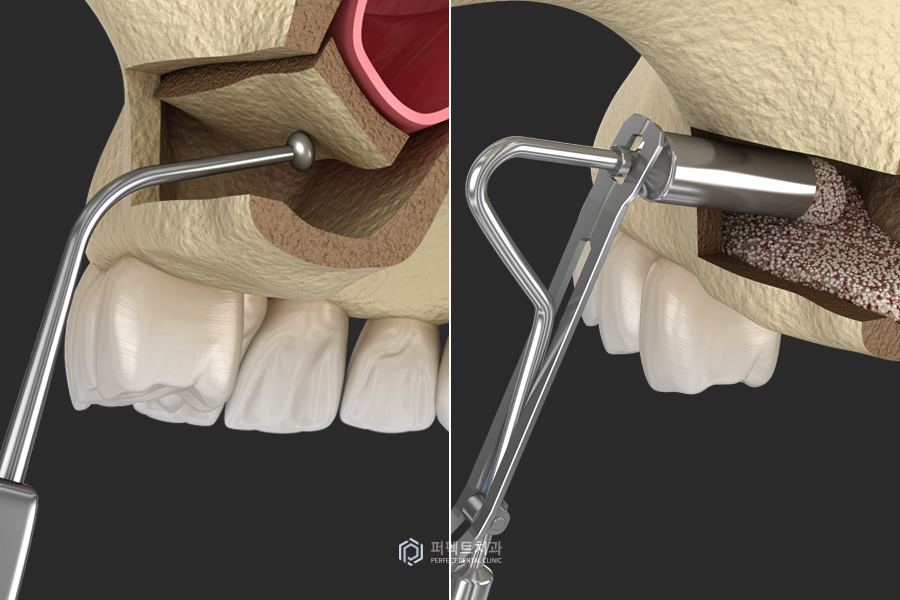 임플란트를 해야하는데 상악동에 염증이..😭 관련 이미지 3