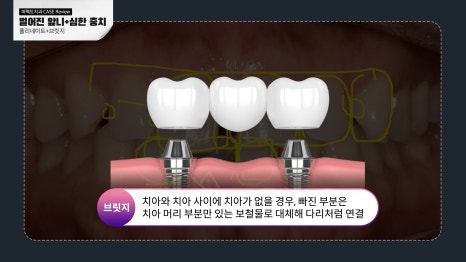 벌어진 앞니 무삭제라미네이트! 관련 이미지 3