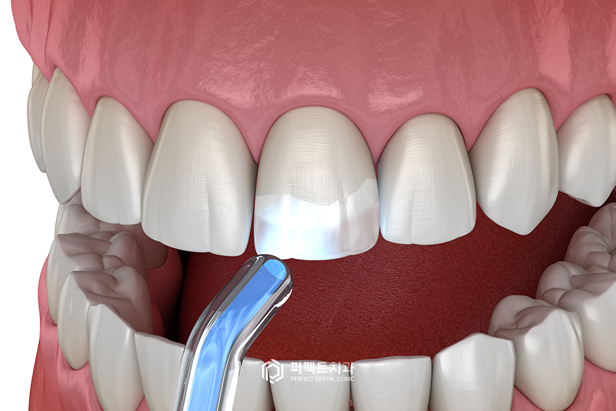 앞니 반점치, 치료 할 수 있는 방법은? 관련 이미지 2