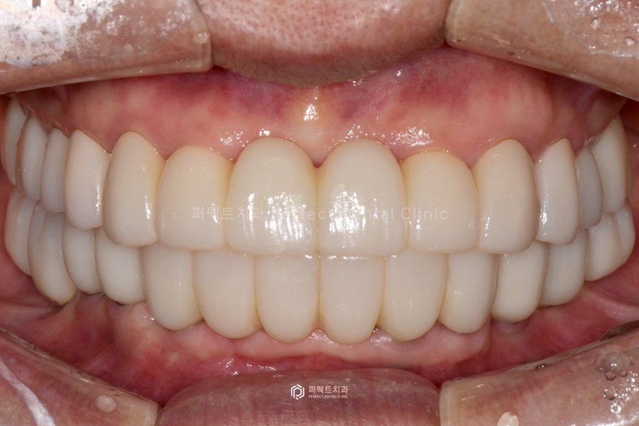 윗니 전체 신경치료 했다고?😱 교합평면이 뭐길래 관련 이미지 11