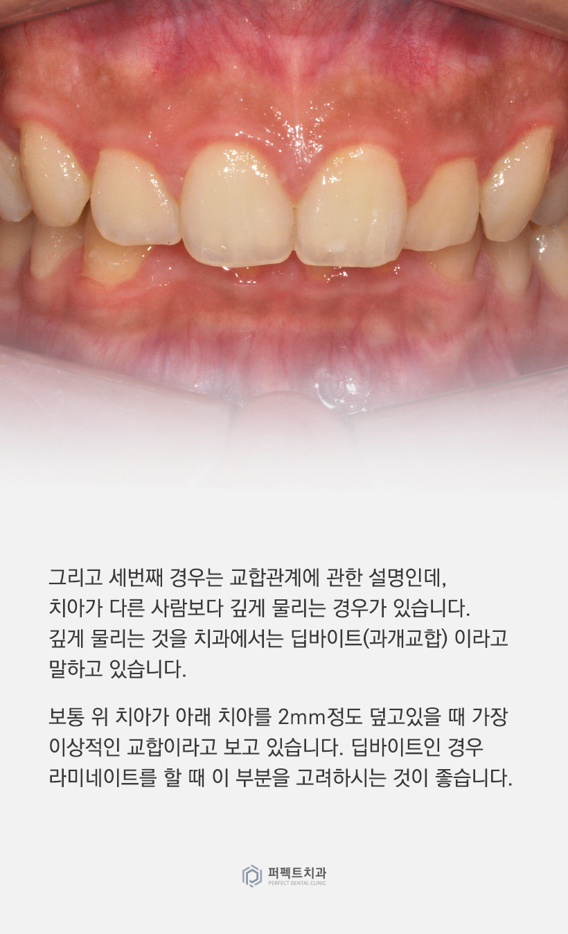 어떤 경우에 라미네이트를 하면 안되나요? 관련 이미지 3