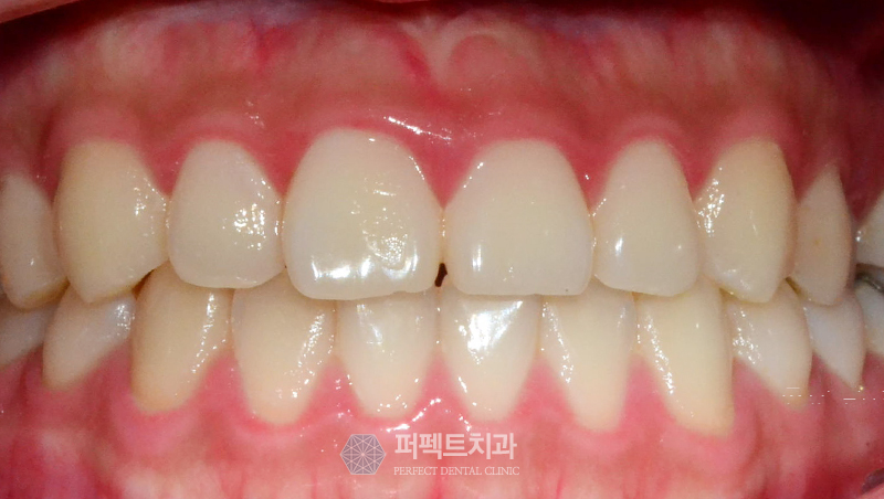 라미네이트 부작용 왜 나타나는 건가요? 관련 이미지 3