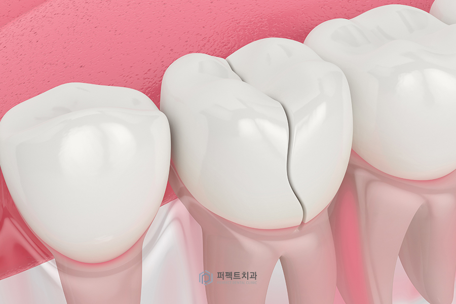 충치치료 했는데 아파요..(크라운&치아크랙) 관련 이미지 2