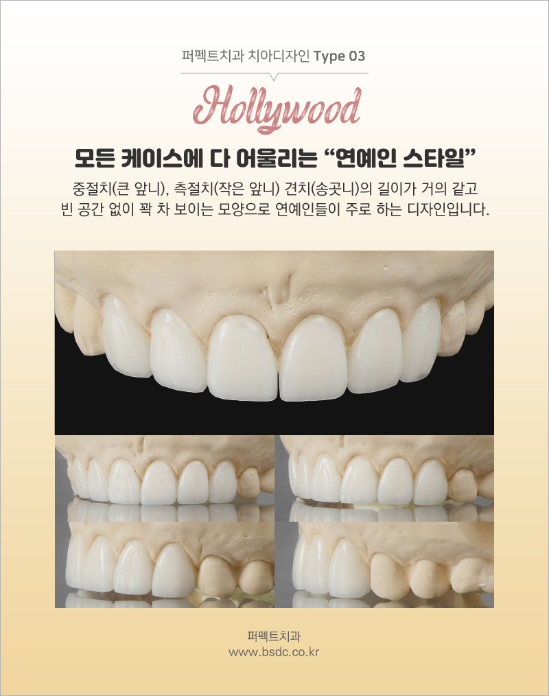 앞니성형 믿고 할 수 있는 치과! 관련 이미지 6