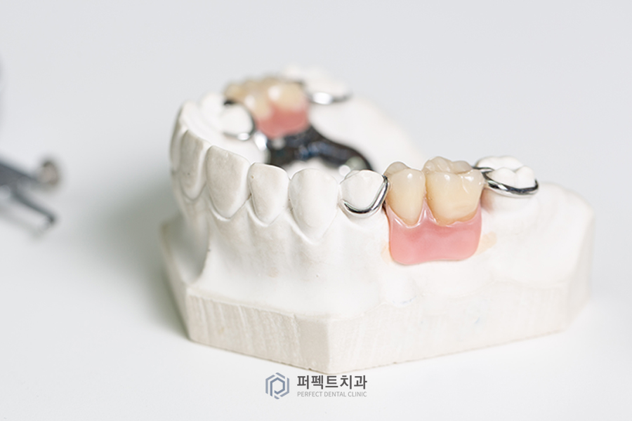 치아가 없을 때 할 수 있는 치료? - ②브릿지/틀니 관련 이미지 2