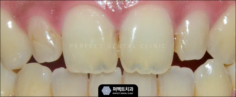 작은치아 왜소치 라미네이트 과정 공개! 관련 이미지 2