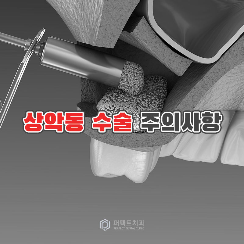 임플란트 수술 후 주의사항은? 관련 이미지 3