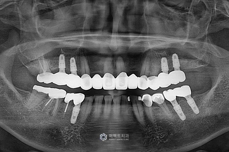 어금니가 없어 앞니로 음식을 드셨던..😰 어떻게 변했을까? 관련 이미지 7