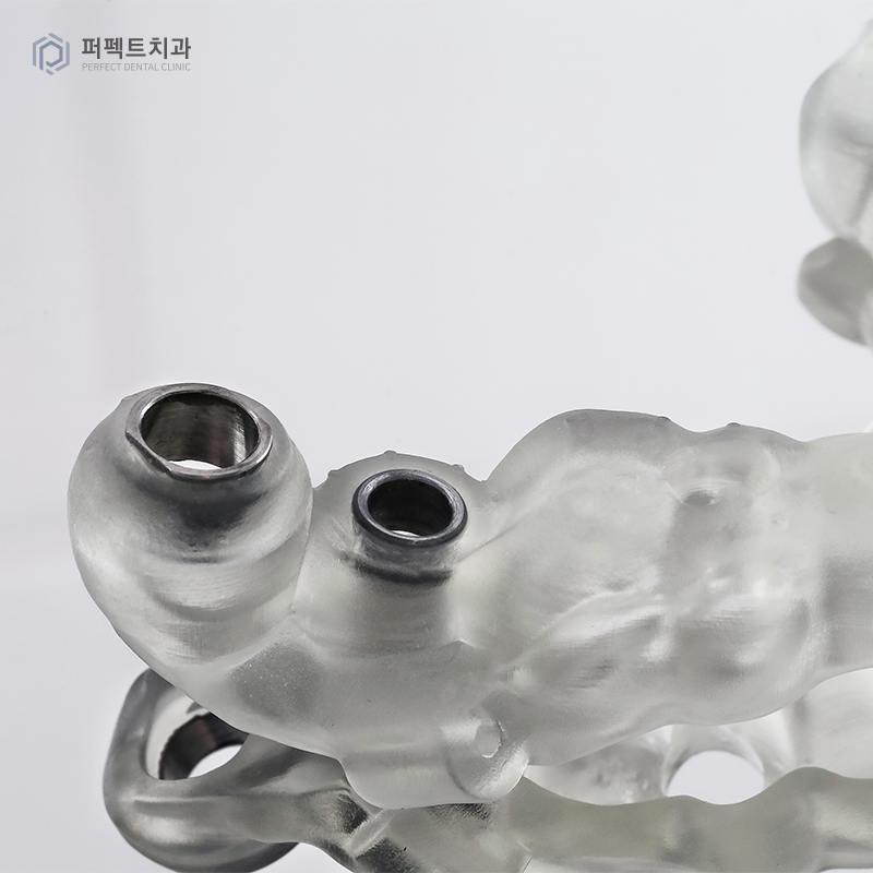 네비게이션 임플란트란? 관련 이미지 6