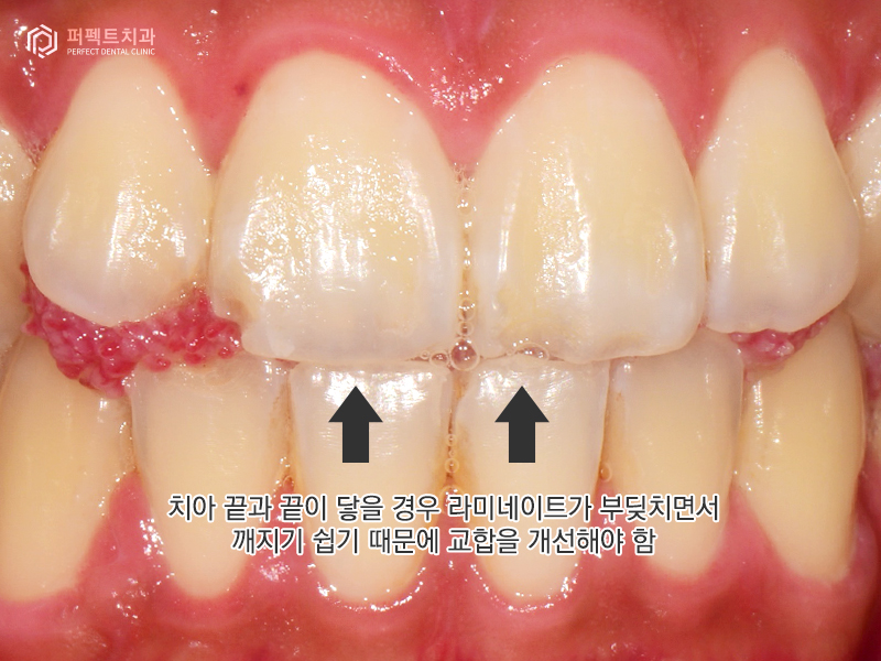 남자라미네이트, 폴리네이트 두가지 케이스 관련 이미지 4