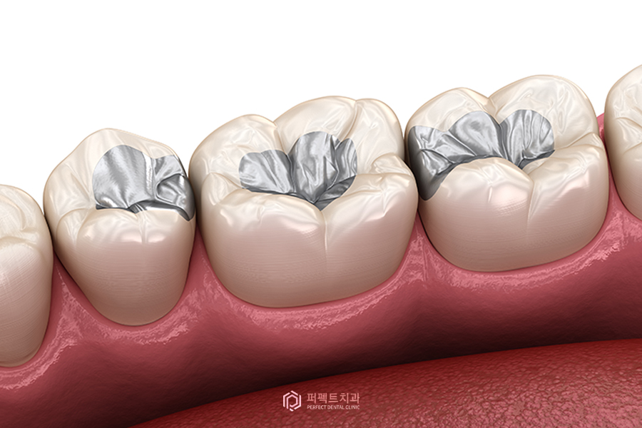 초기 충치치료, 어떤 재료가 있을까? 관련 이미지 2