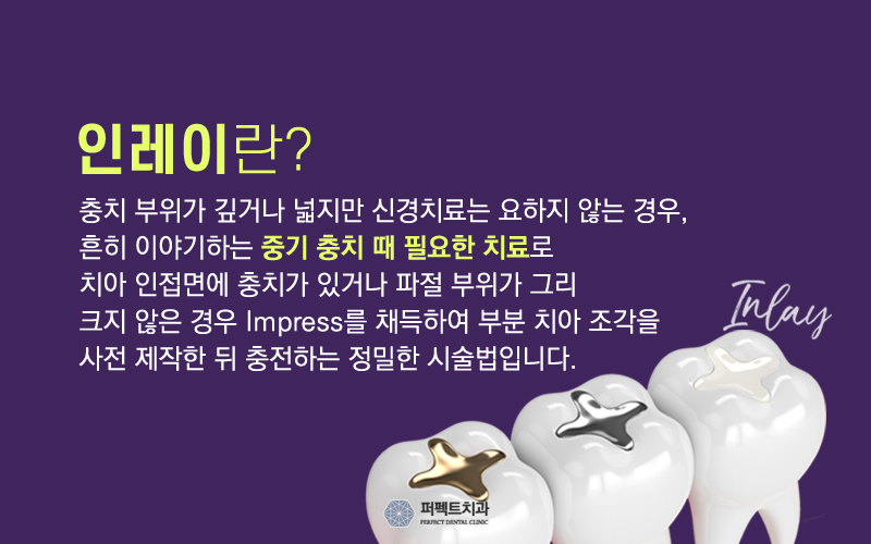 5월달 충치치료 저렴한 인레이 비용! 관련 이미지 1
