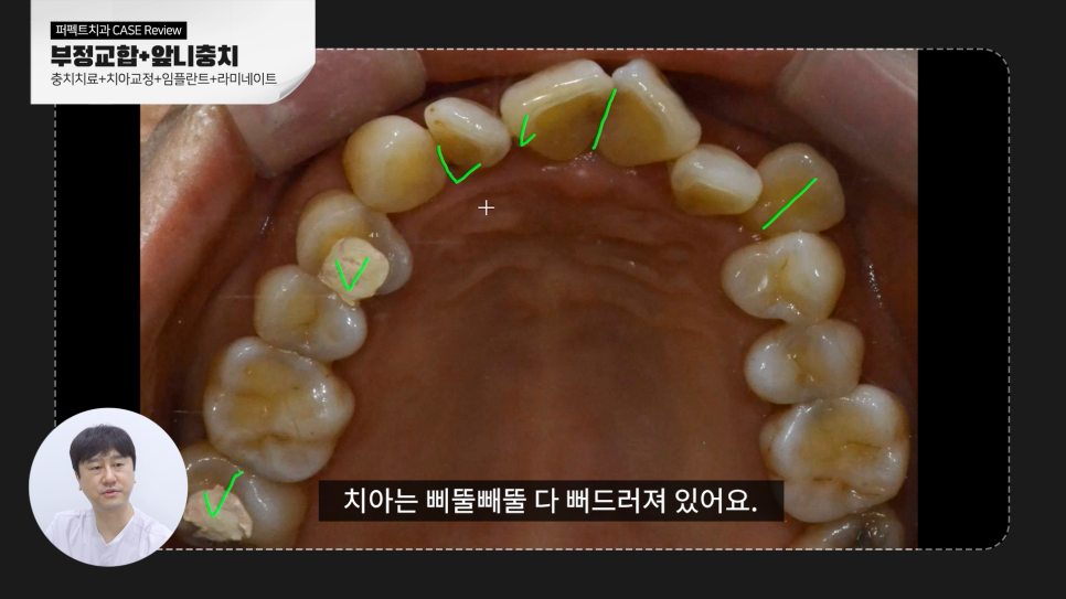 [부정교합+충치] 복합적인 문제를 가진 치아, 치료결과는? 관련 이미지 4