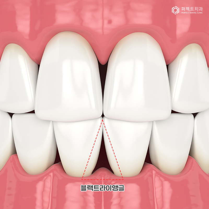 교정 후 잇몸퇴축은 흔하게 생기나요? 관련 이미지 2