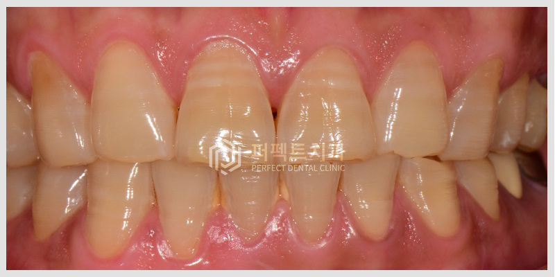 테트라사이클린 치아변색 치료 관련 이미지 1