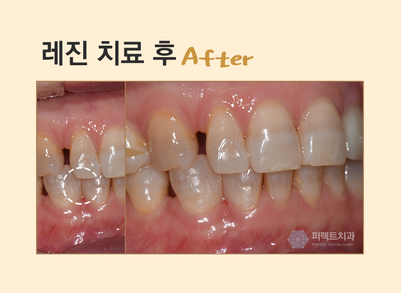 레진필링으로 벌어진 치아 메꾸자 관련 이미지 5