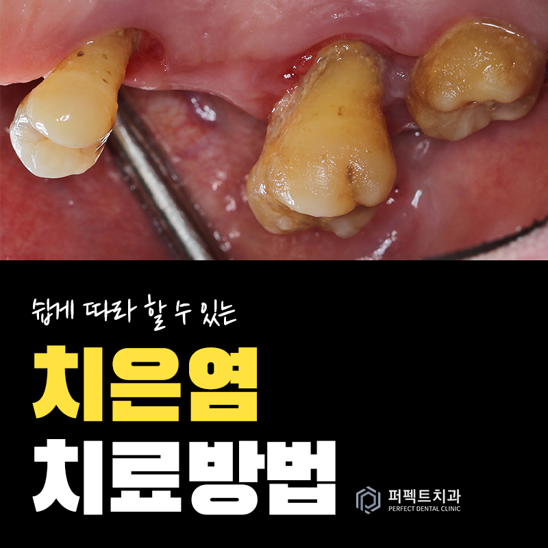 치은염 치료법과 증상 관련 이미지 1