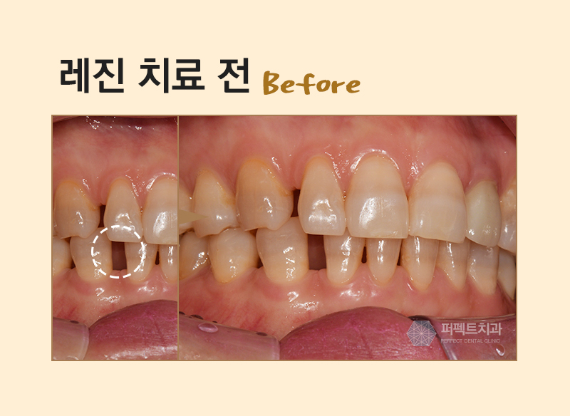 레진필링으로 벌어진 치아 메꾸자 관련 이미지 4